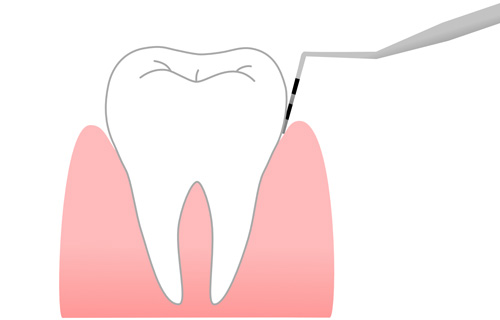 歯周ポケット検査