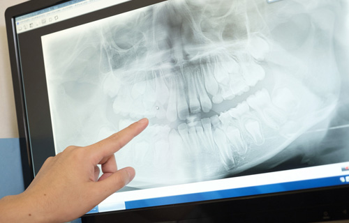 レントゲン検査